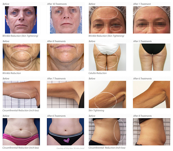 Before & After with Venus Freeze